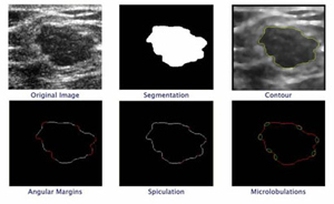 An�lisis im�genes de tumores por ultrasonido ULPGC