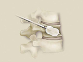 Cirugia de columna