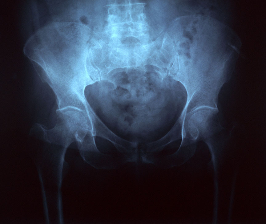 Radiograf�a de la pelvis