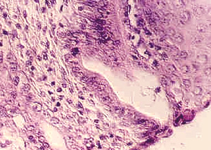 Mucosa uni�n gastroesofagica